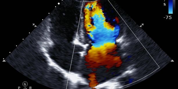 Ecocardiograma 2D + Doppler