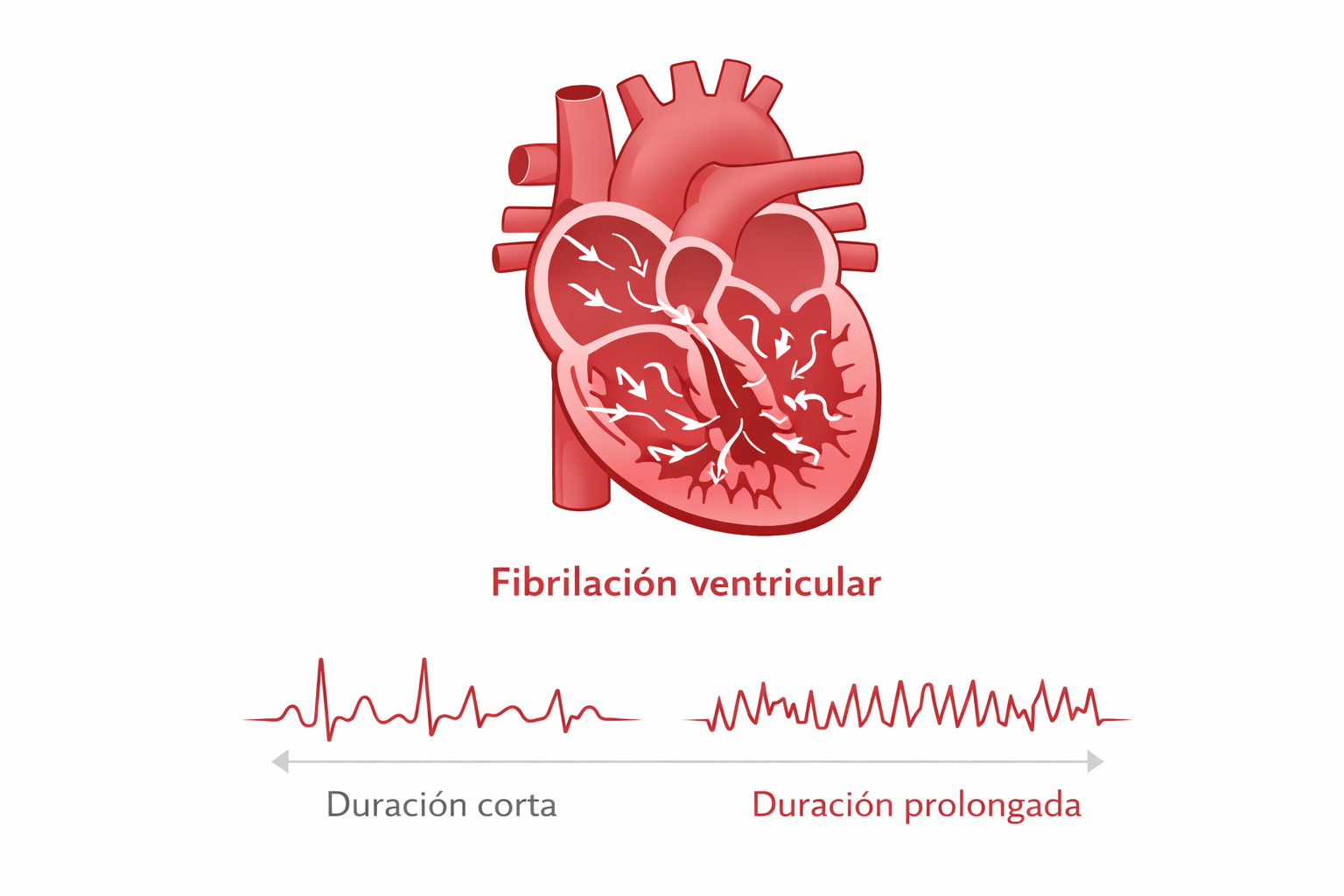 EGC de una fibrilación ventricular