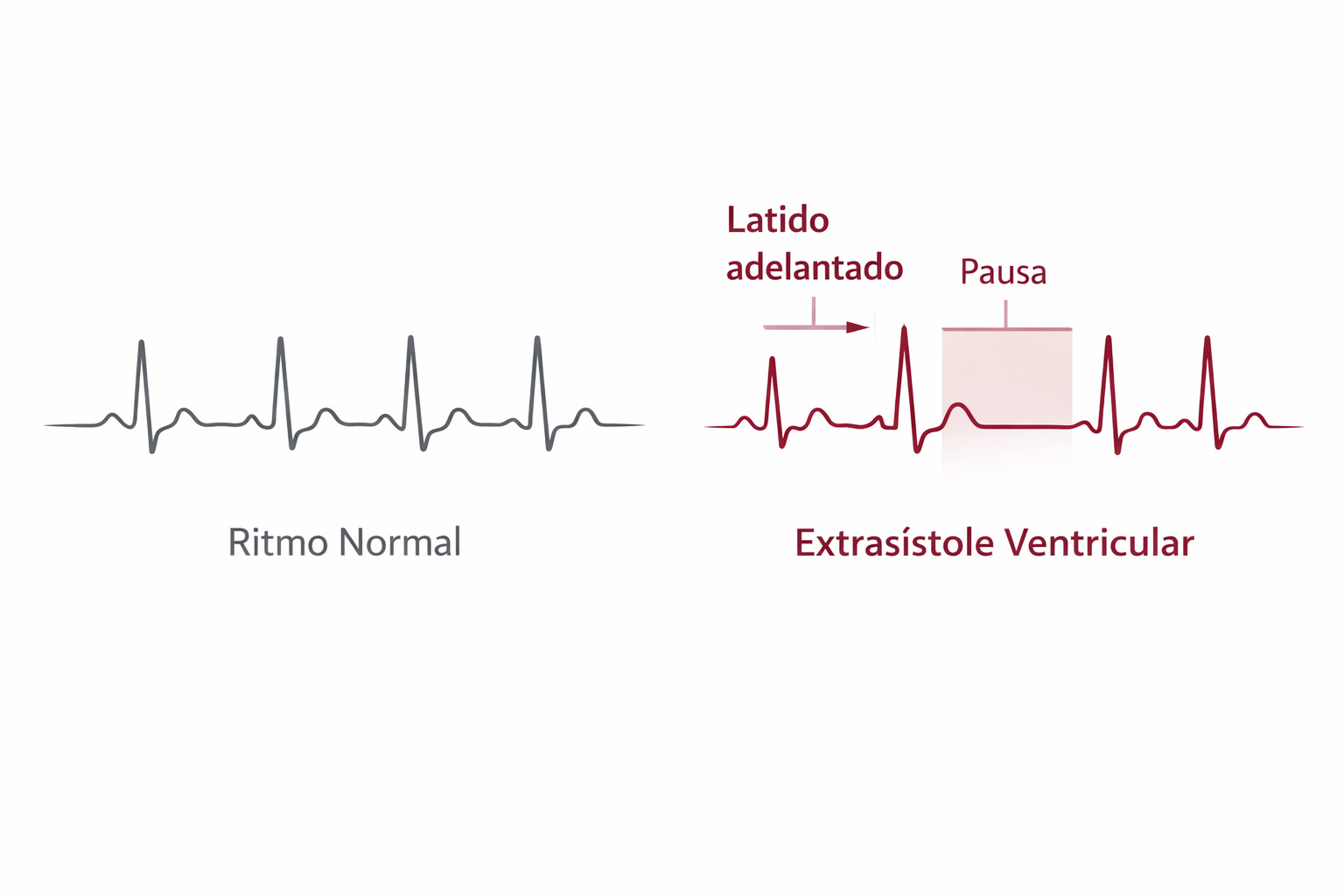 Comparativa: extrasístoles ventriculares