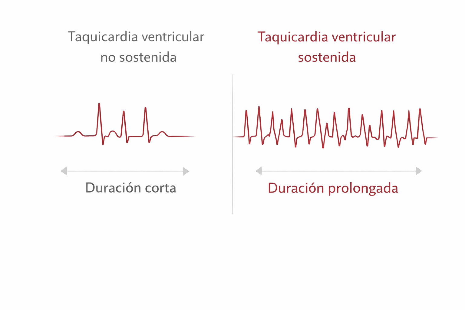 Taquicardia ventricular