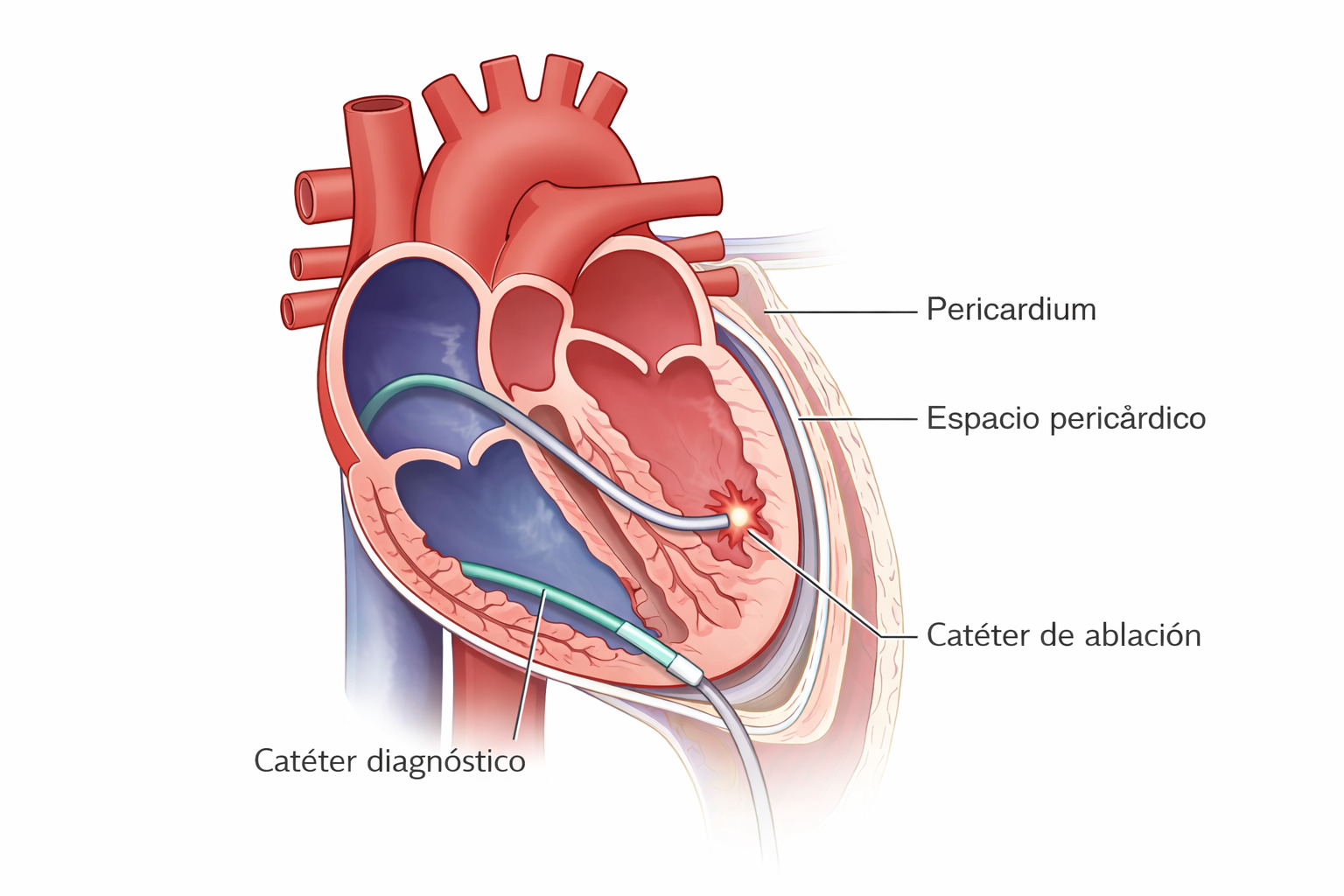 Vista anatómica de un corazón con una ablación cardíaca